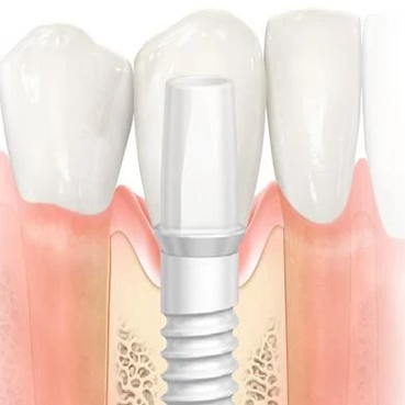 implant dentaire en zircone à Cergy le Beaufay